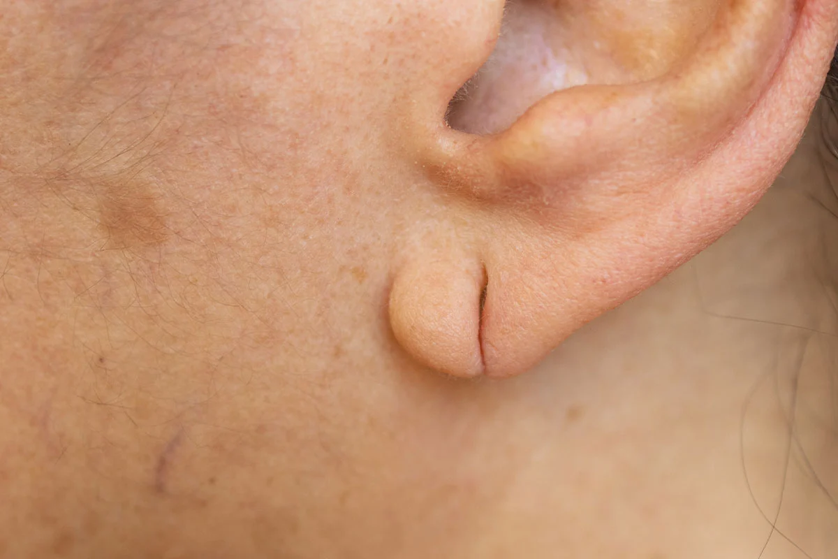 Close-up of repaired earlobe showing surgical closure of split or stretched piercing