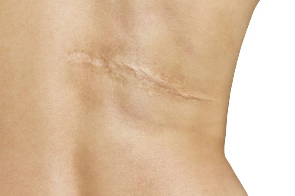 Close-up of a healed surgical scar on skin showing fine line closure