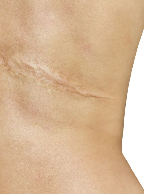 Close-up of a thin, well-healed scar on the inner forearm or wrist