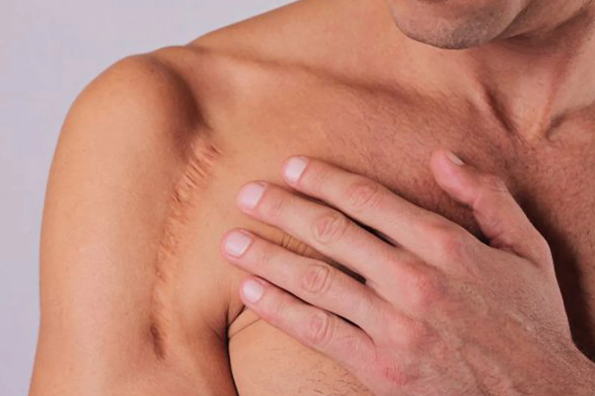Man's hand on a woman's shoulder showing a thin linear scar on the upper arm