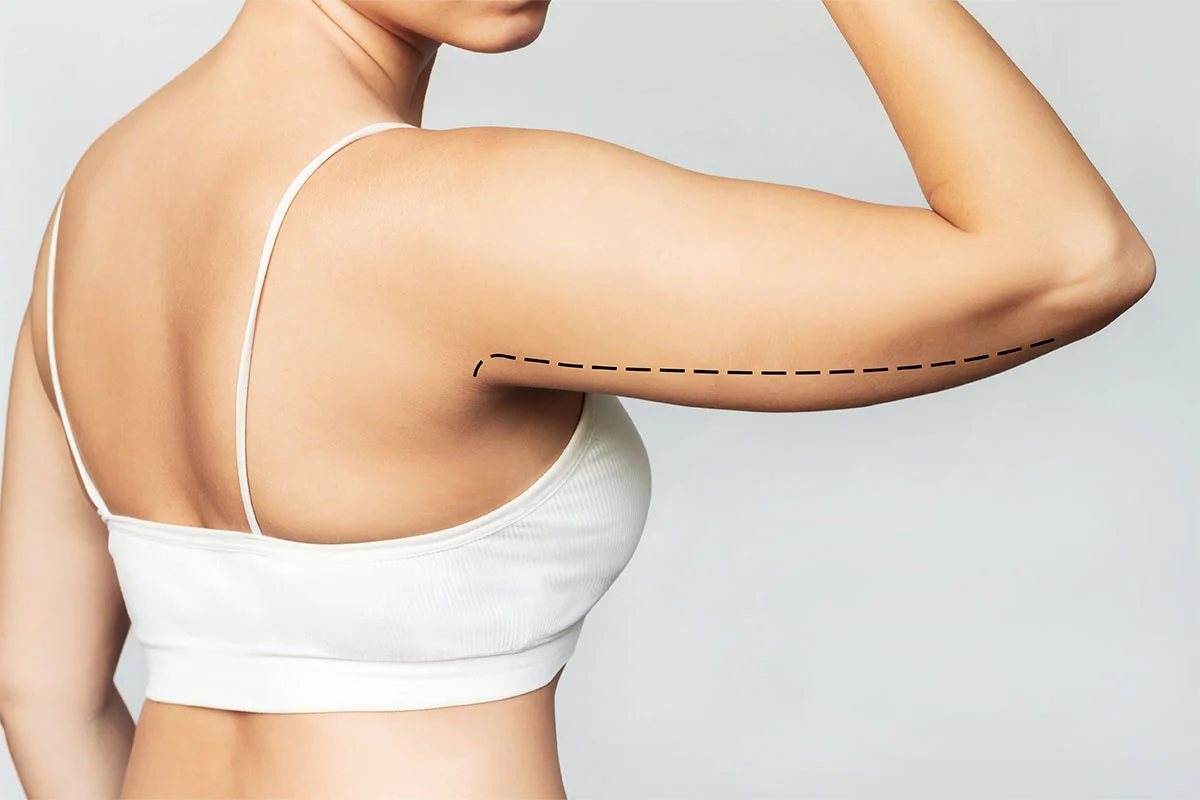 Woman's arm flexed with dashed line marking arm lift surgical area
