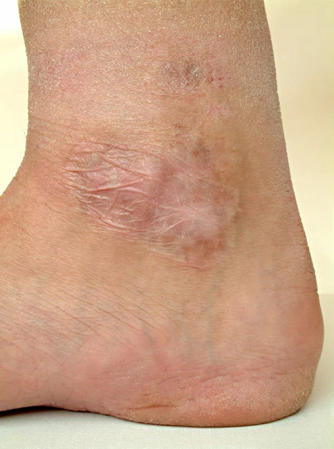 Close-up of a surgical scar on the ankle and lower leg against a neutral background