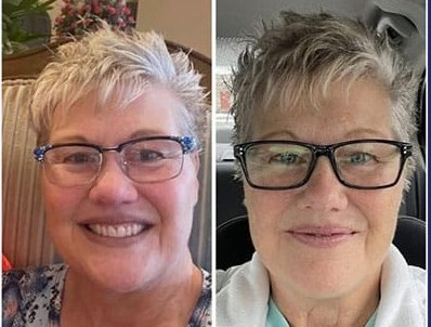Woman shown before and after eye transformation procedure