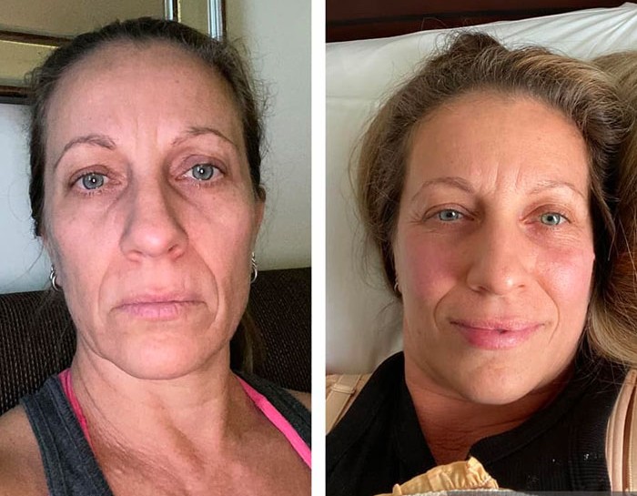 Before and after facial transformation showing improved eye area definition and overall facial rejuvenation