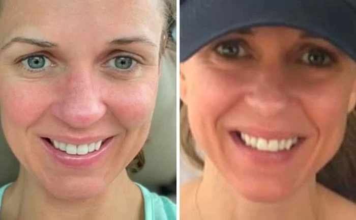 Before and after facial transformation showing improved eye area and overall facial appearance