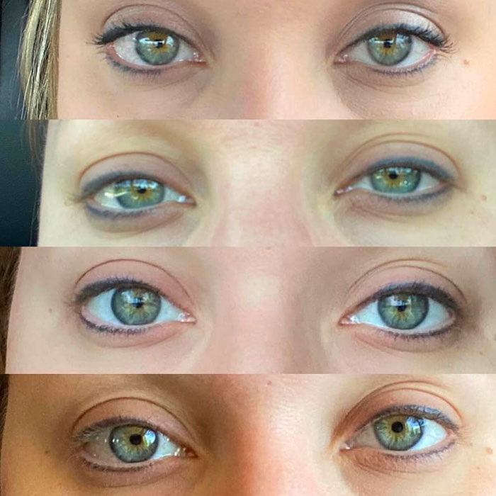 Four sets of before-and-after eye close-ups showing reduced under-eye bags and improved eyelid contour