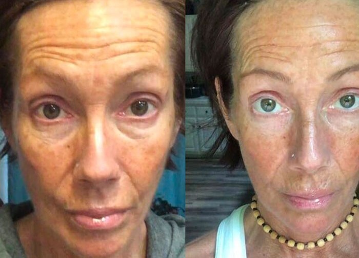 Before and after full-face comparison showing reduced forehead wrinkles and improved facial contours