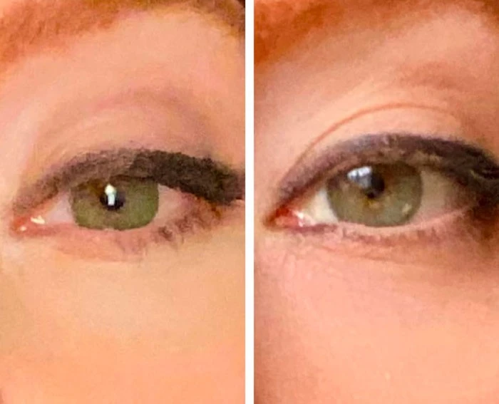 Before and after close-up eye comparison showing reduced drooping and improved upper eyelid appearance