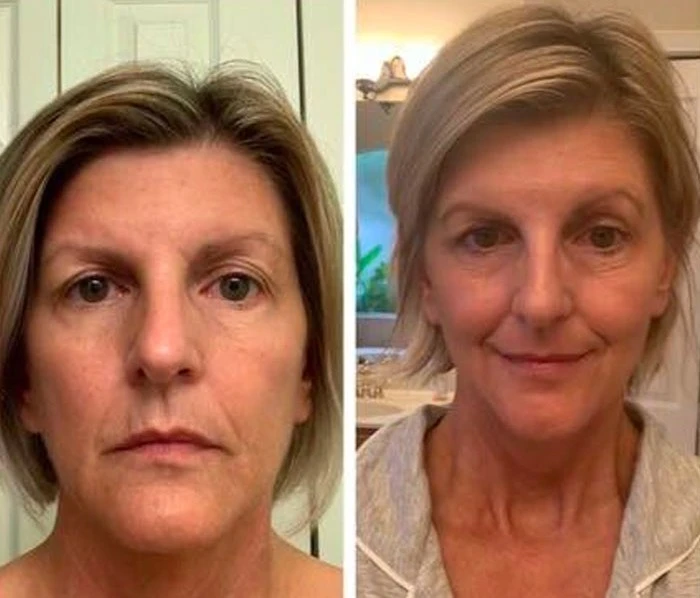 Before and after full-face comparison showing improved facial definition and reduced under-eye aging