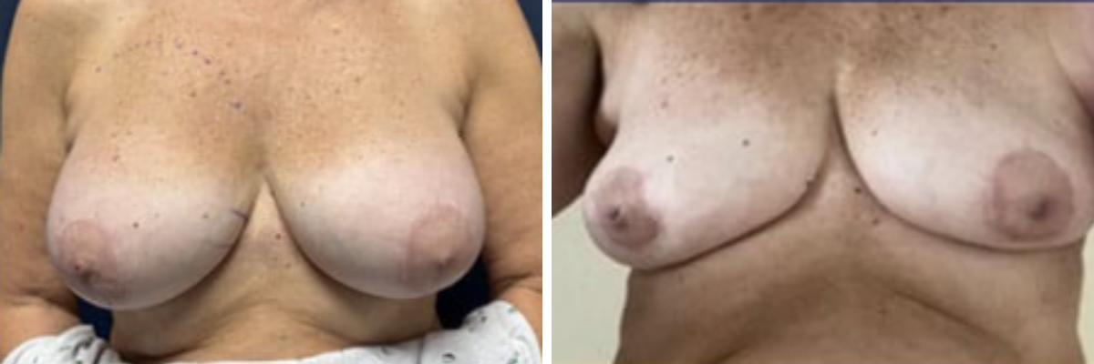 Before and after surgical result showing breast appearance change
