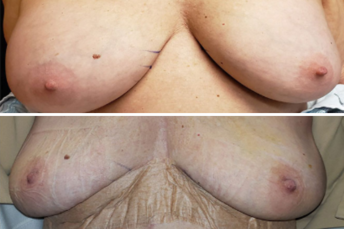 Breast explant pre-op and post-op comparison showing surgical results after implant removal