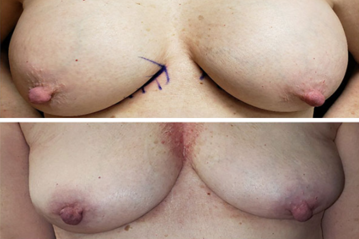 Breast explant surgery before and after: pre-operative markings above, post-operative results below showing reduced volume