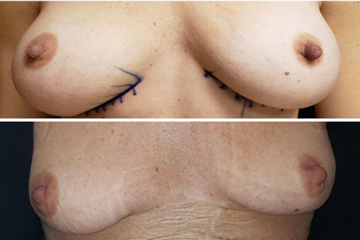 Breast explant surgery before and after: pre-operative surgical markings above, post-operative results below