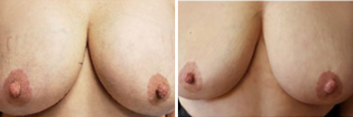 Before and after breast explant surgery showing smaller, naturally proportioned breasts