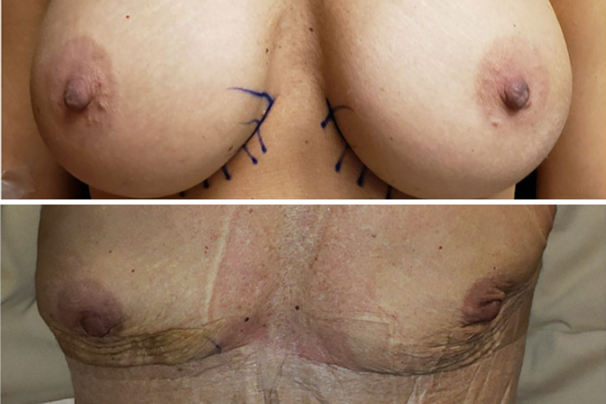 Breast explant surgery before and after: pre-operative surgical markings above, post-operative results below