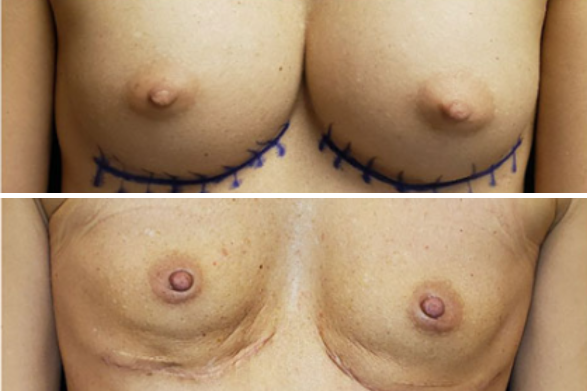 Breast explant pre-op with surgical markings showing planned incision lines below breasts