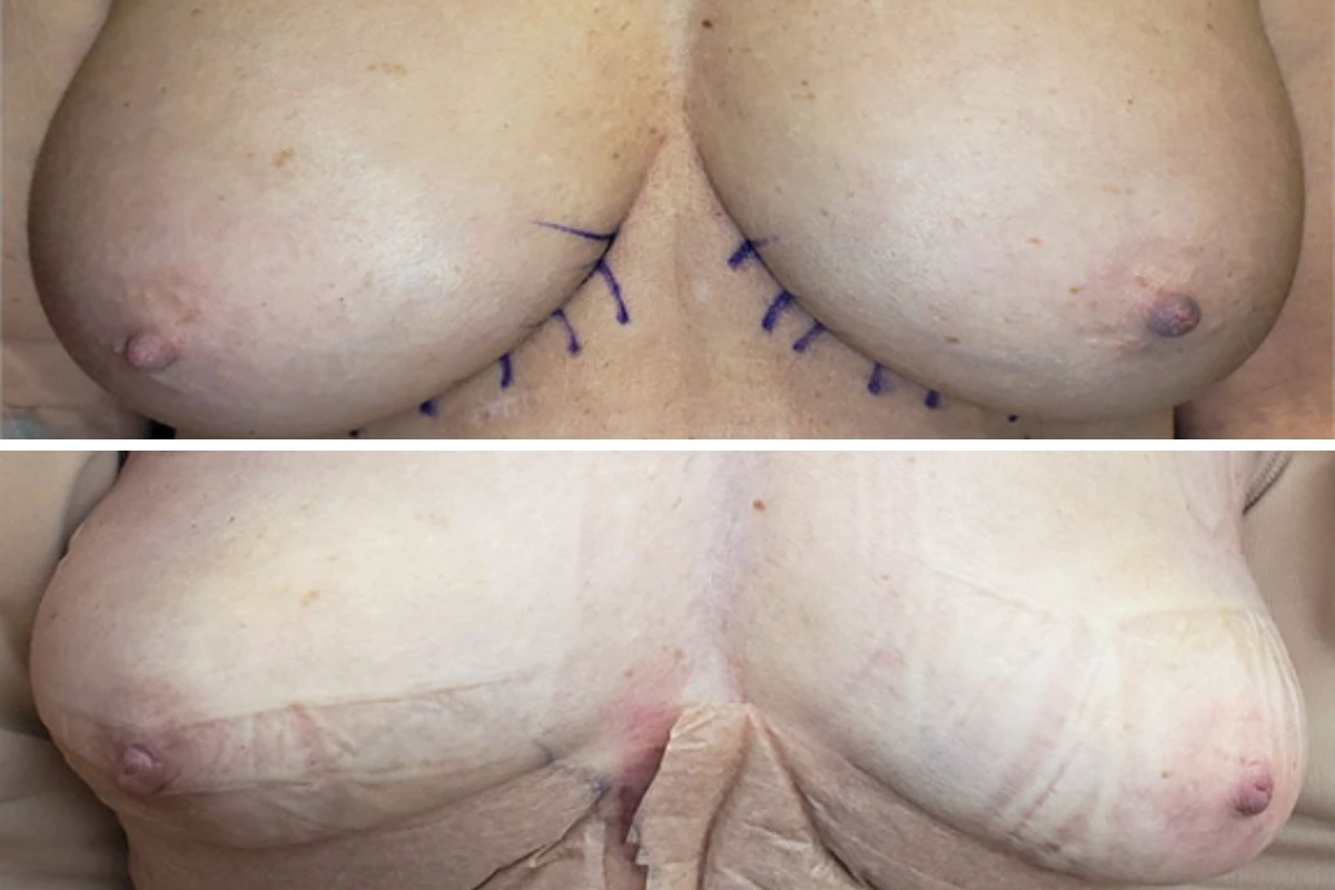 Breast explant pre-op with surgical planning markings on chest tissue