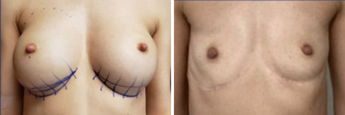 Before explant surgery with surgical markings and after surgery showing results