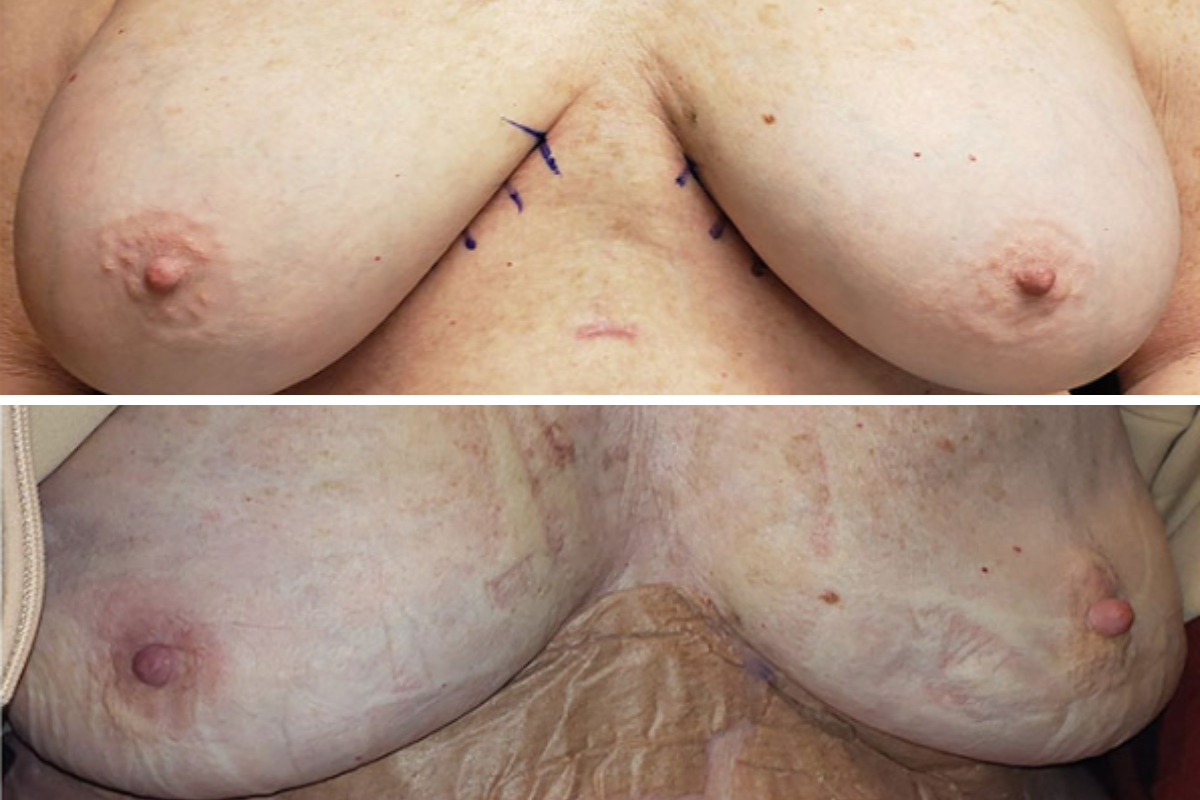 Breast explant pre-op with incision markings and surgical planning indicators