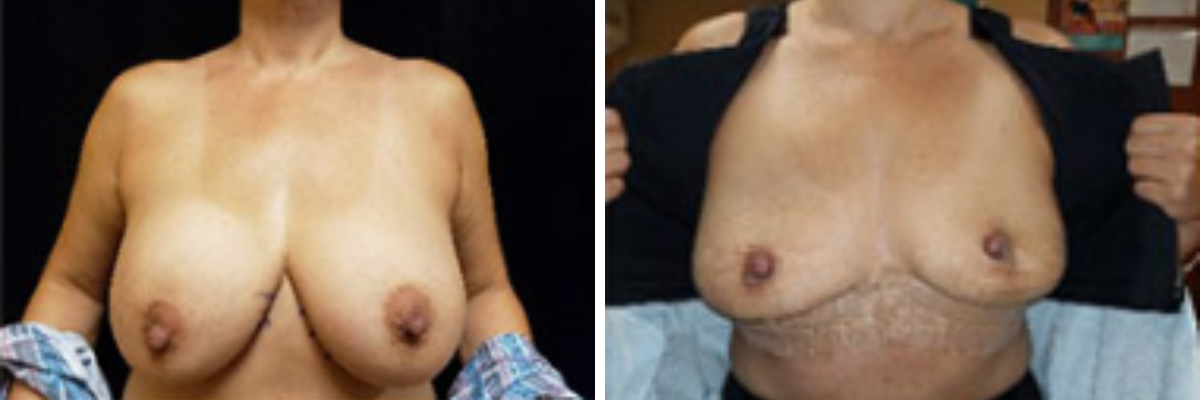 Before and after breast explant surgery showing reduced breast size and shape