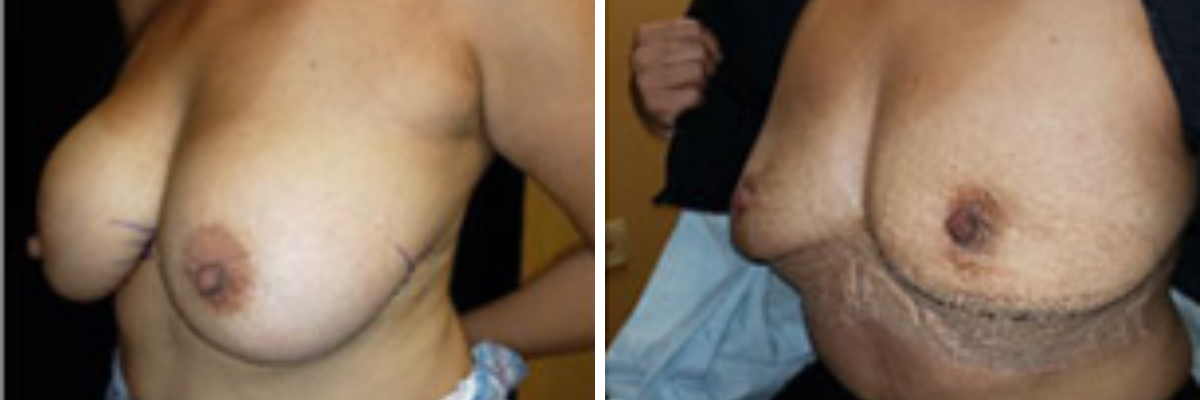 Before and after breast explant surgery showing decreased volume and natural contour