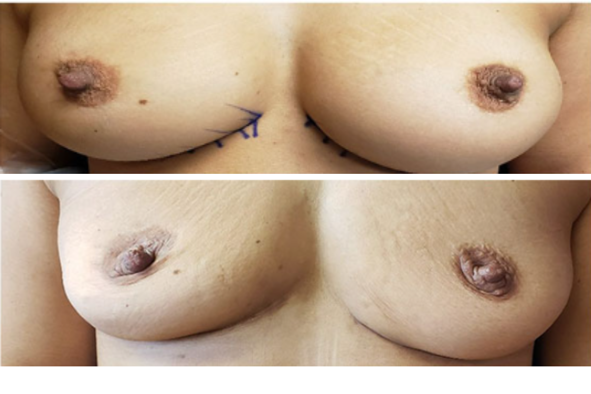 Before and after breast explant with surgical marking indicating incision plan and post-procedure results