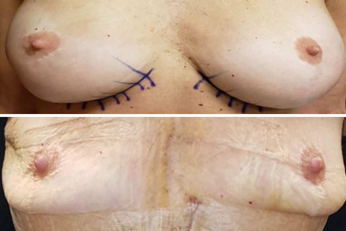 Before and after breast explant with bilateral surgical incision markings and reduced breast projection