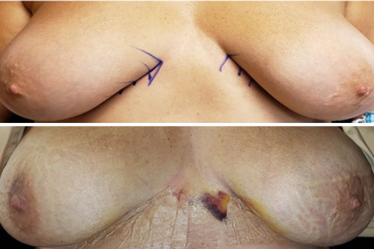 Breast explant pre-op marking with surgical arrows indicating incision placement