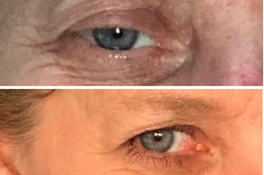 Before and after eye transformation showing reduced wrinkles and improved eyelid skin texture