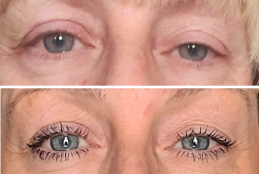 Before and after eye transformation showing reduced drooping and enhanced lash appearance