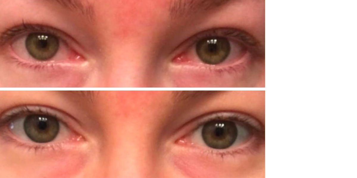 Before and after eye transformation showing reduced redness and improved eye area appearance