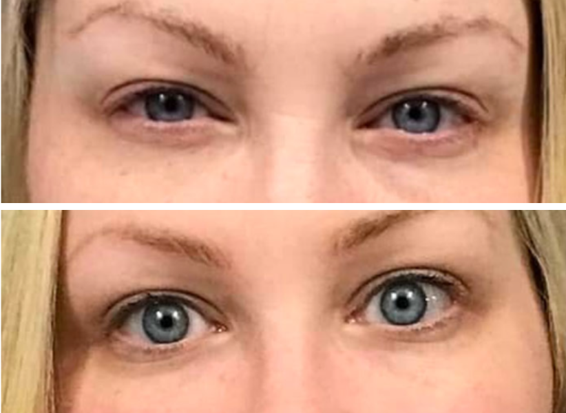 Before and after eye transformation showing reduced under-eye bags and puffiness
