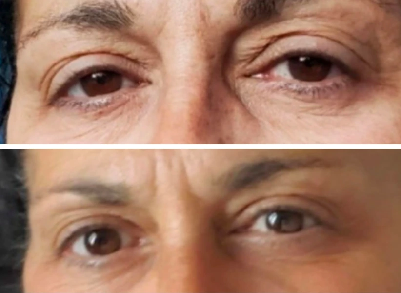 Before and after eye transformation showing reduced wrinkles and improved eyelid appearance