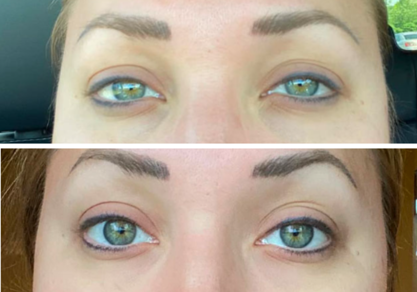 Before and after eye transformation showing improved eyelid contour and reduced drooping