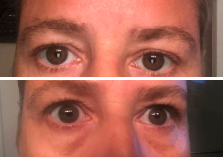 Before and after eye transformation showing reduced under-eye bags and puffiness