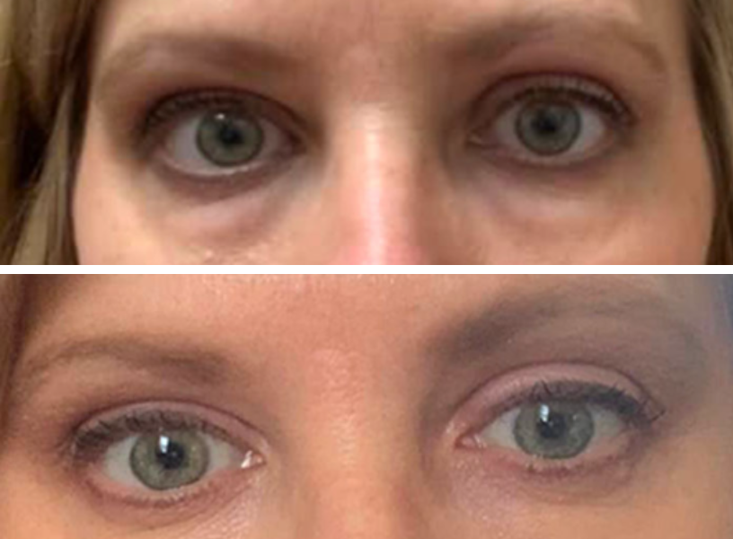 Before and after comparison of eye appearance showing transformation results
