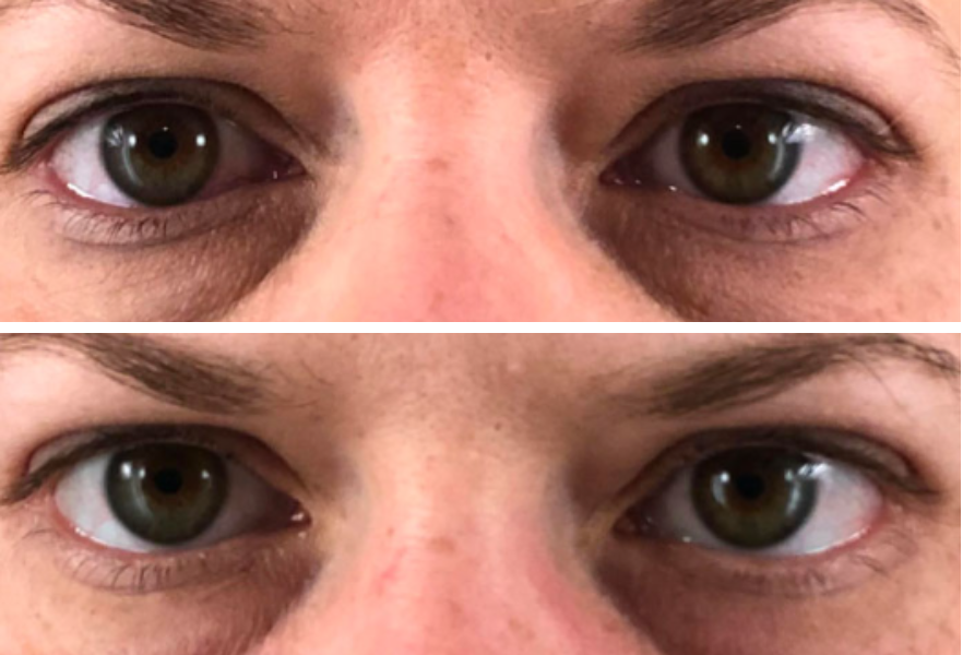 Before and after eye transformation showing reduced under-eye hollowing and improved eye area definition