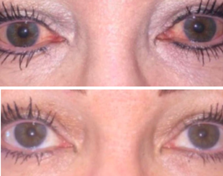 Before-and-after eye transformation showing reduced under-eye wrinkles and improved lower lid appearance