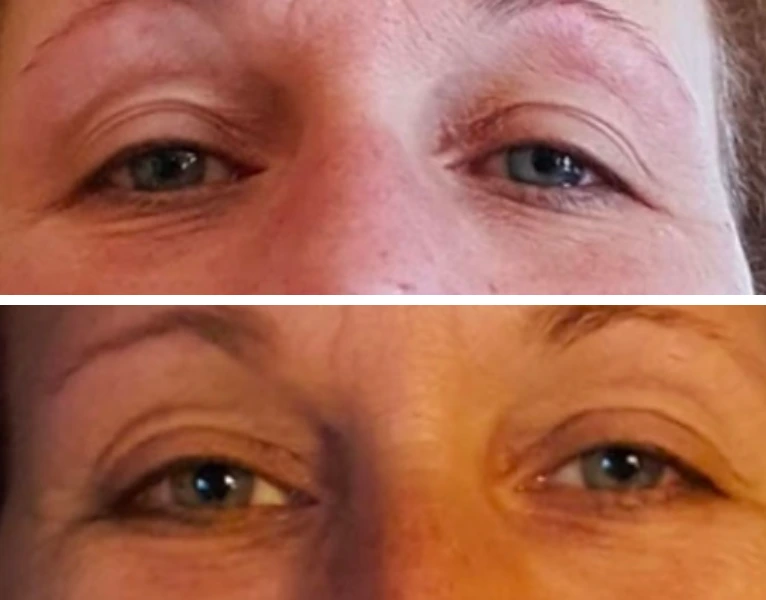Before-and-after eye close-ups showing reduced crow's feet and smoother periorbital skin