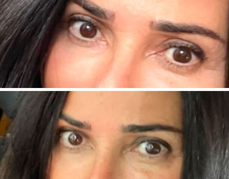 Before-and-after frontal eye view showing reduced under-eye darkness and improved lid definition