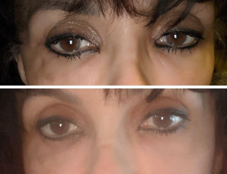 Before-and-after eye close-ups showing improved upper eyelid contour and reduced shadowing