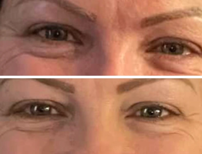 Before and after close-up of eyes showing reduced upper eyelid drooping and crepiness