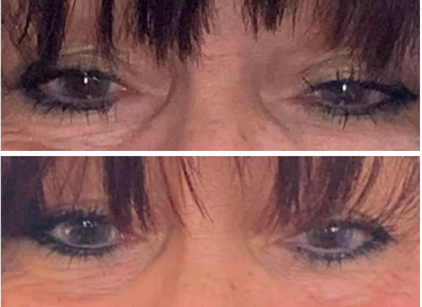Before and after eye area comparison showing reduced under-eye bags and improved skin texture