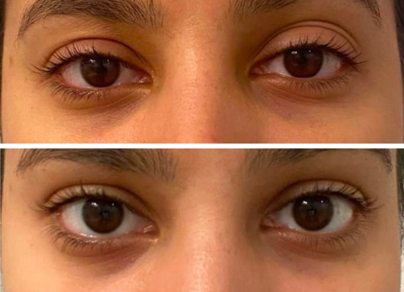Before and after eye area comparison showing reduced under-eye hollowing and improved eyelid definition