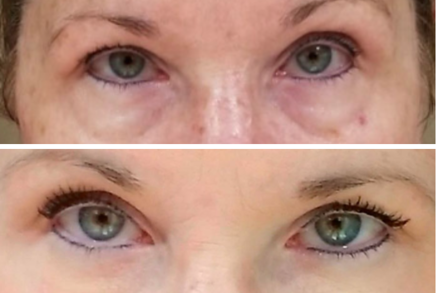 Before and after eye area comparison showing reduced puffiness and improved eyelid lift and lash appearance