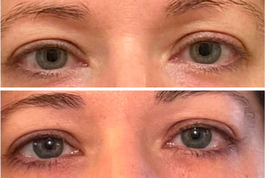 Before and after eye transformation showing reduced under-eye bags and improved eyelid appearance
