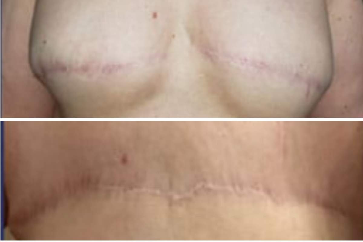 Before and after breast surgery comparison showing flat closure technique results