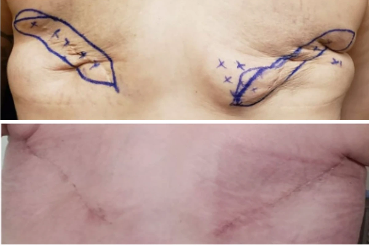 Chest marked with surgical guidelines for flat closure procedure, with healed scar result below