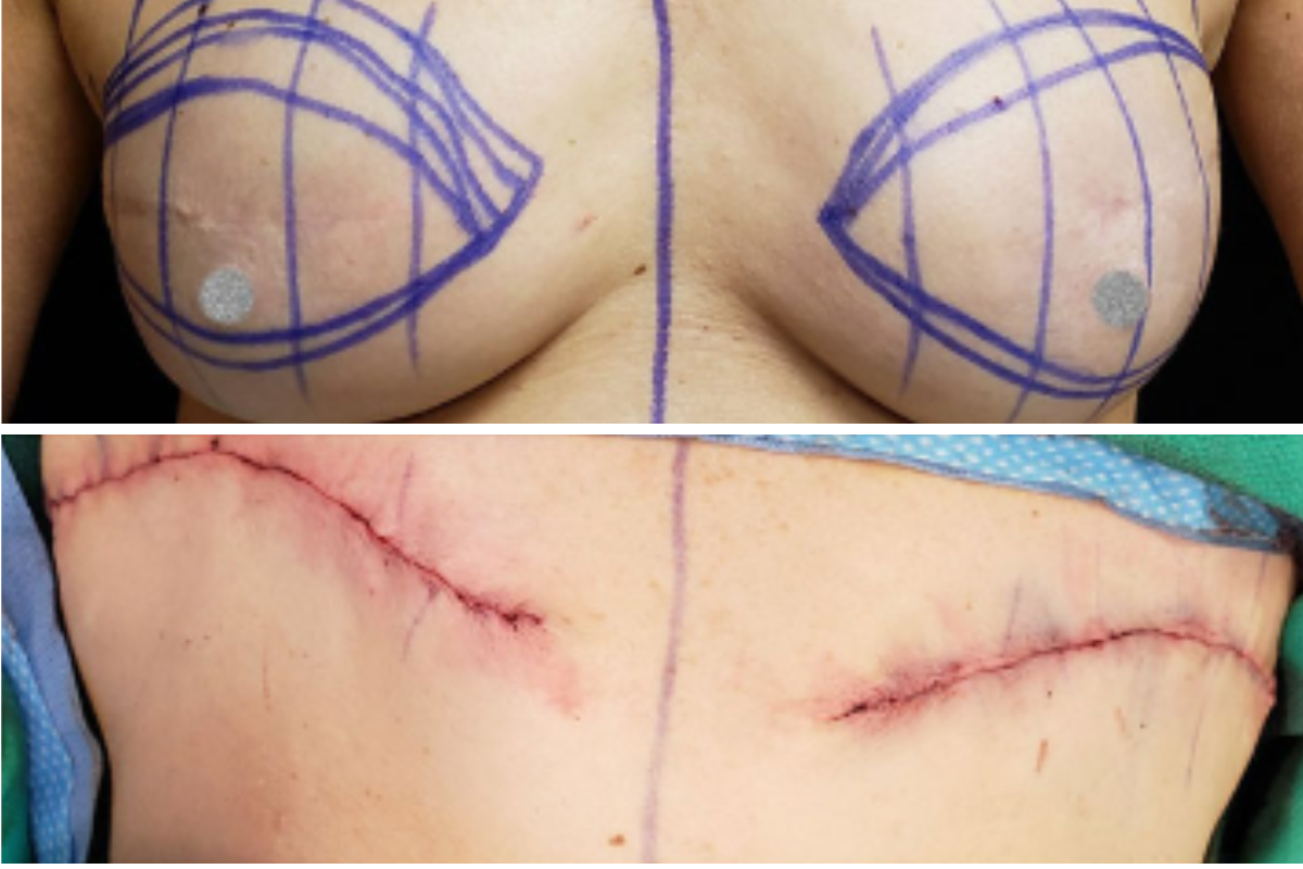 Breasts marked with surgical planning grid for flat closure technique, with post-operative scarring shown below
