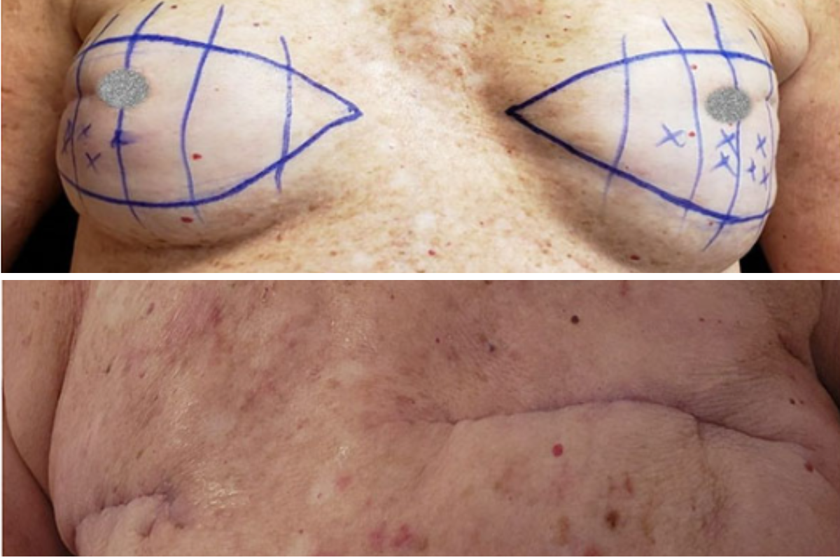 Breast lift surgery pre-operative planning: markings indicating surgical incision pattern and reshaping design